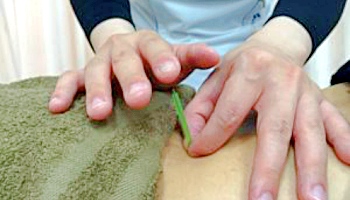 札幌市西区で鍼灸治療が得意な整骨院